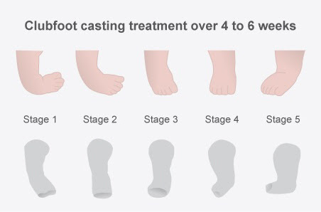 Human Biology Online Lab Clubfoot Maray Singleton