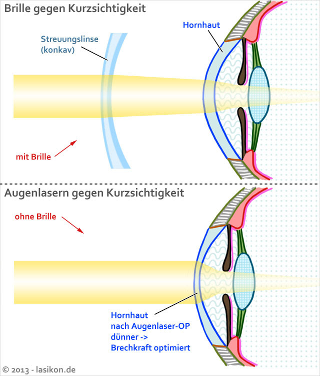 Augenlasern bei kurzsichtigkeit