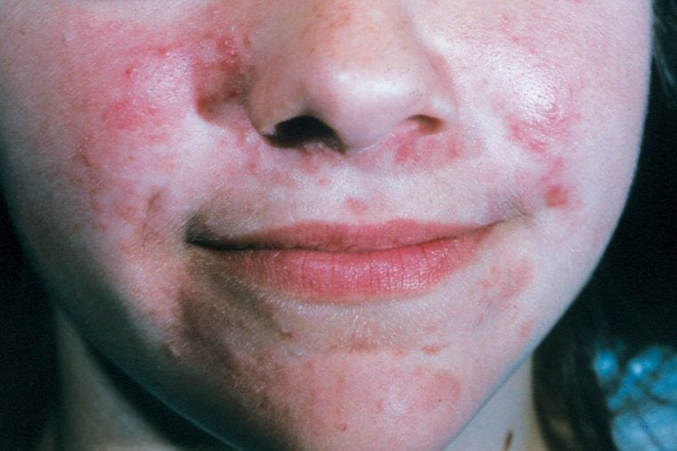 perioral-dermatitis