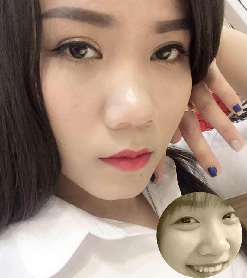 Cắt mí mắt1
