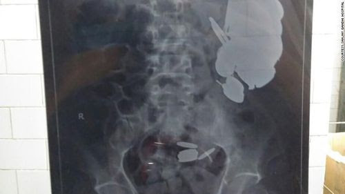 Dokter Angkat 263 Koin dan 100 Paku dari Perut Pria di India