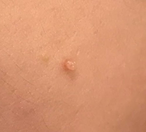ホクロ イボ治療 韮崎市の皮膚科 美容皮膚科ならさおり皮ふ科クリニック