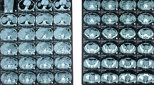 gan-100-khoi-u-duoc-bac-si-boc-tach-cuu-song-benh-nhan