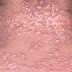 Lupus Pernio Sarcoidosis / What Is Lupus Pernio (Pictures)? - Healthtopquestions - HTQ - (a) subcutaneous nodules without changes in overlying epidermis.
