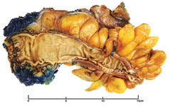 Anterior Resection Of The Colon