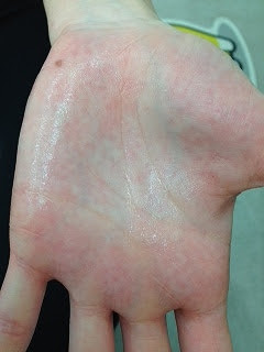 手汗が多い 野田市 小児科 千葉県 こどもの花粉症 こどもの漢方 喘息 アトピー性皮膚炎 アレルギー 結節性痒疹 たんぽぽこどもクリニック