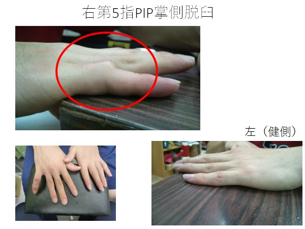 突き指 脱臼 むずかしい指の脱臼の整復 はずれた関節をはめる 長崎市のはしぐち整骨院 日曜営業 交通事故治療 足底筋膜炎