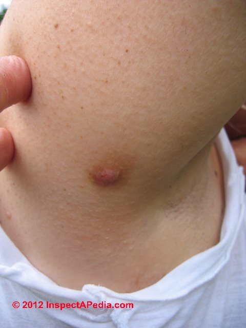 asbestos signs in adults