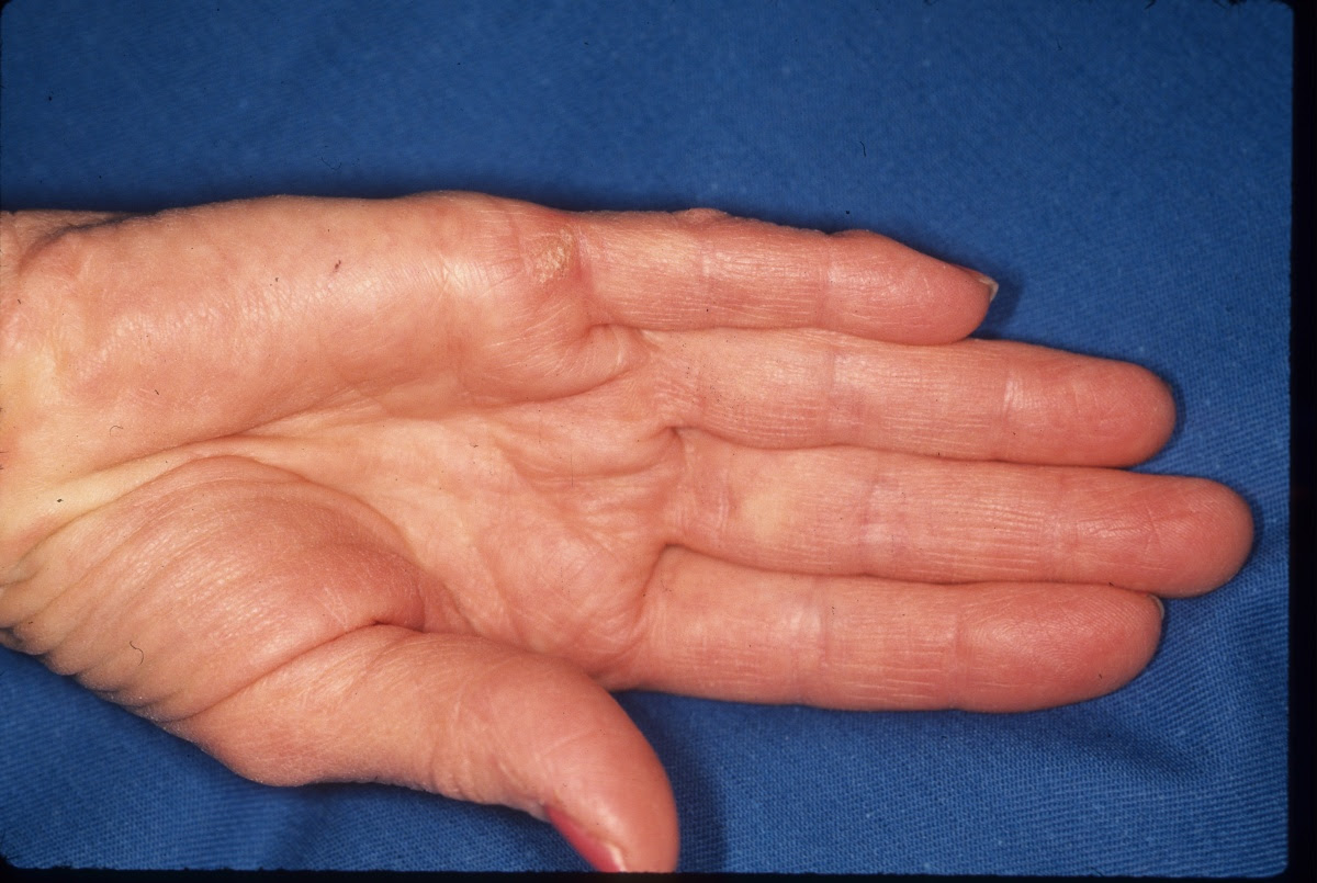 Tumor Wart Curettage