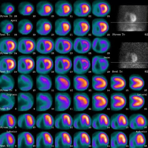 myocardial perfusion imaging