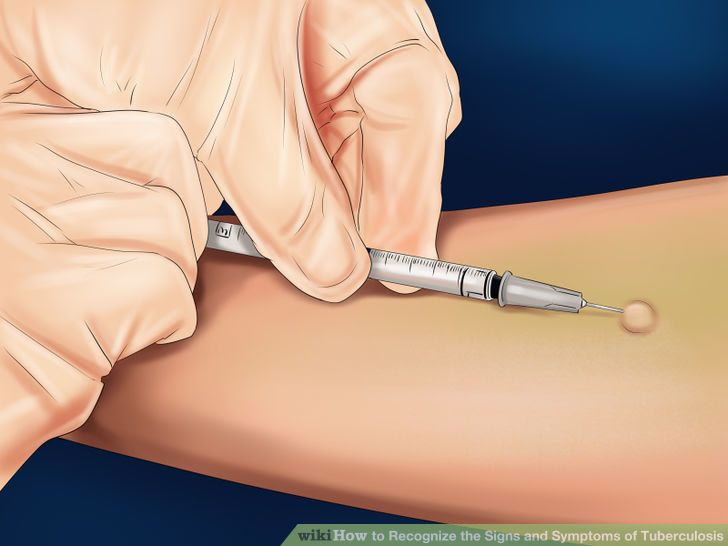 Recognize the Signs and Symptoms of Tuberculosis Step 14.jpg
