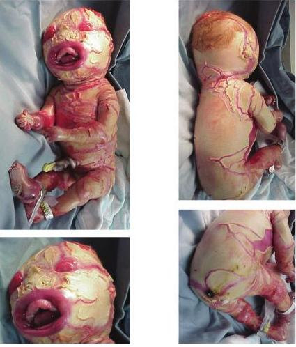 Harlequin Baby Syndrome  pulut KUNING