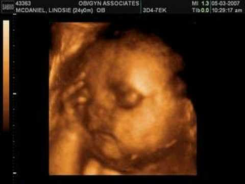 3d ultrasound pictures of twins. Ava Mae McDaniel 3D Ultrasound; Ava Mae McDaniel 3D Ultrasound. shawnce. Aug 1, 10:00 AM 3d ultrasound pictures of twins. 3d ultrasound pictures of twins. Ava Mae McDaniel 3D Ultrasound; Ava Mae McDaniel 3D Ultrasound. shawnce. Aug 1, 10:00 AM