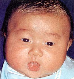 乳児脂漏性湿疹