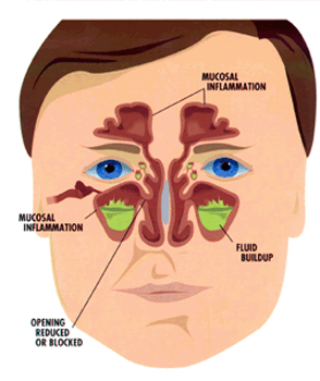 nasal polyps treatment in cats