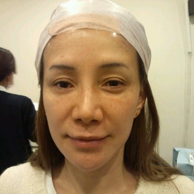 切らない小鼻縮小