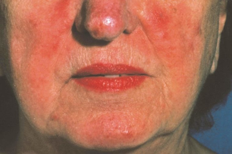 rosacea