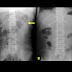 Sentinel Loop Sign In Acute Pancreatitis : State that the mortality rate is 28.3% within five years in patients with cn.|the common issue is an early diagnosis and an appropriate treatment, in case of an acute phase where it is difficult to differentiate an acute osteomyelitis.