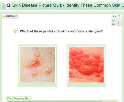 Molluscum Contagiosum Home Remedies, Treatment amp; Symptoms