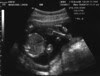 bumpy_19wks3