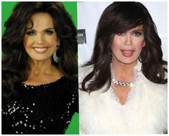 Marie Osmond cosmetic surgery before and after photos