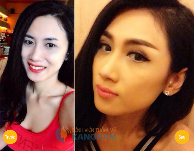 Cắt mí mắt trên Hàn Quốc loại bỏ HOÀN TOÀN bọng mỡ thừa 4