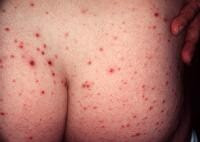 Typical hemorrhagic crusted papules of pityriasis...