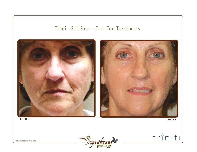 ... Gallery - Symphony Laser Center | King of Prussia, Philadelphia, PA