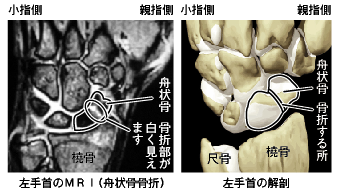 飯島整形外科 ドクター飯島のスポーツ医学ｑ A 外反母趾