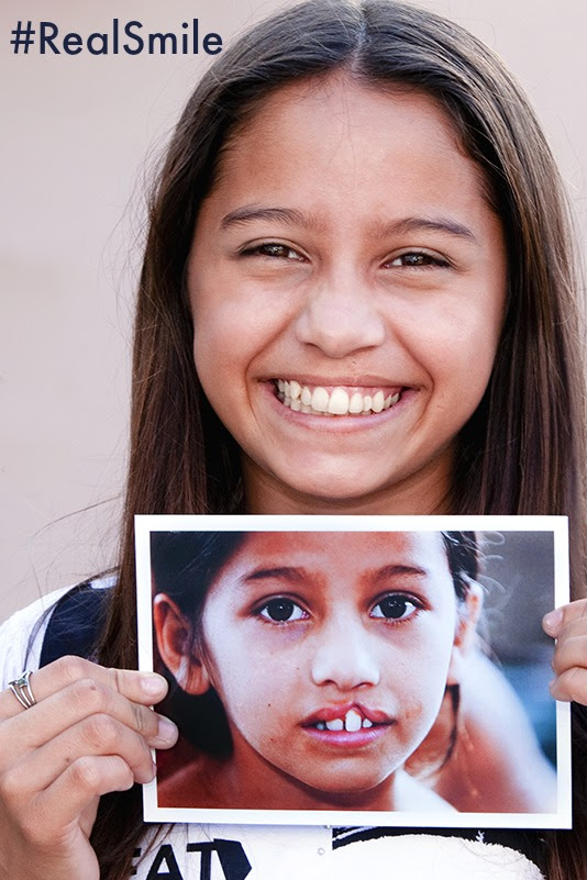 RealSmile for Operation Smile Donation