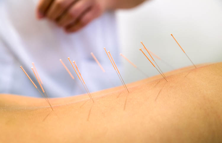 Acupuncture And Lower Back Pain Lbp Acuhealth