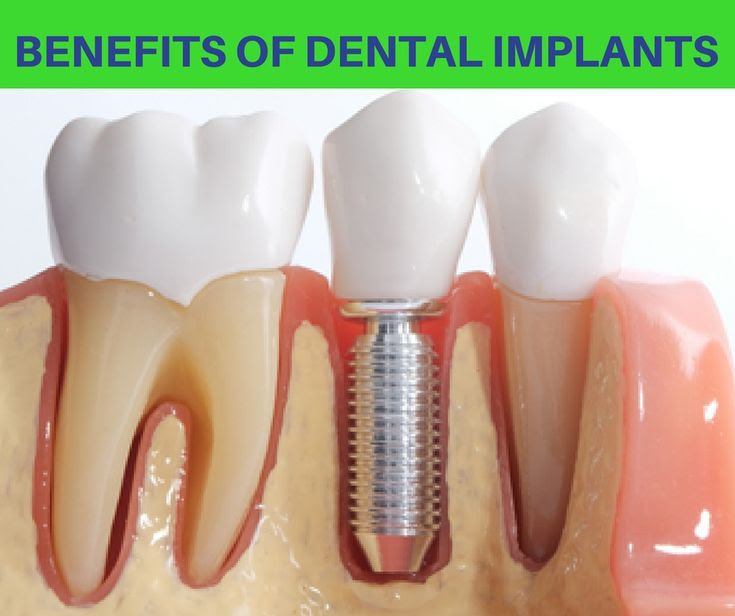 Root Canal Procedure Prep, Steps, Pain, and Recovery Time