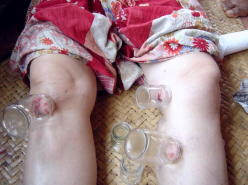 三宅漢方医院のボランティア活動 ミャンマーseed 吸い玉療法トレーニング 漢方のことなら福岡市の三宅漢方医院