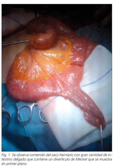 Littré´s hernia: unusual find in inguino-scrotal hernial 
