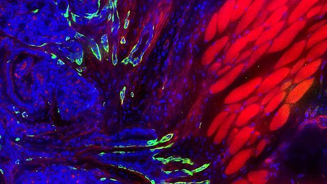 Identifican el «punto débil» de la metástasis del cáncer