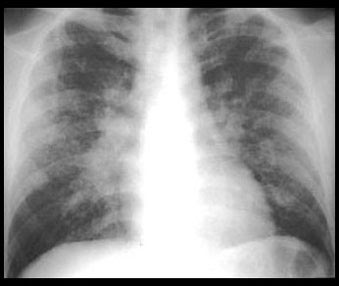 Image Of Sarcoidosis Lung Parenchymal Disease