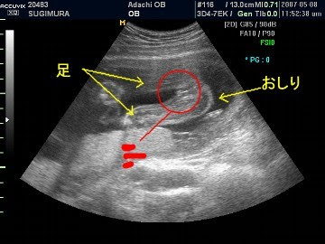 ２１ｗ５ｄ ６ヶ月検診 わたしのたからもの
