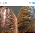 Hair Fall Out After Laser