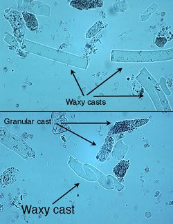 Urinalysis Flashcards  Easy Notecards