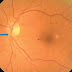 Could TGI predict risk of Retinal Vein Occlusion in at-risk individuals with a simple calculation?