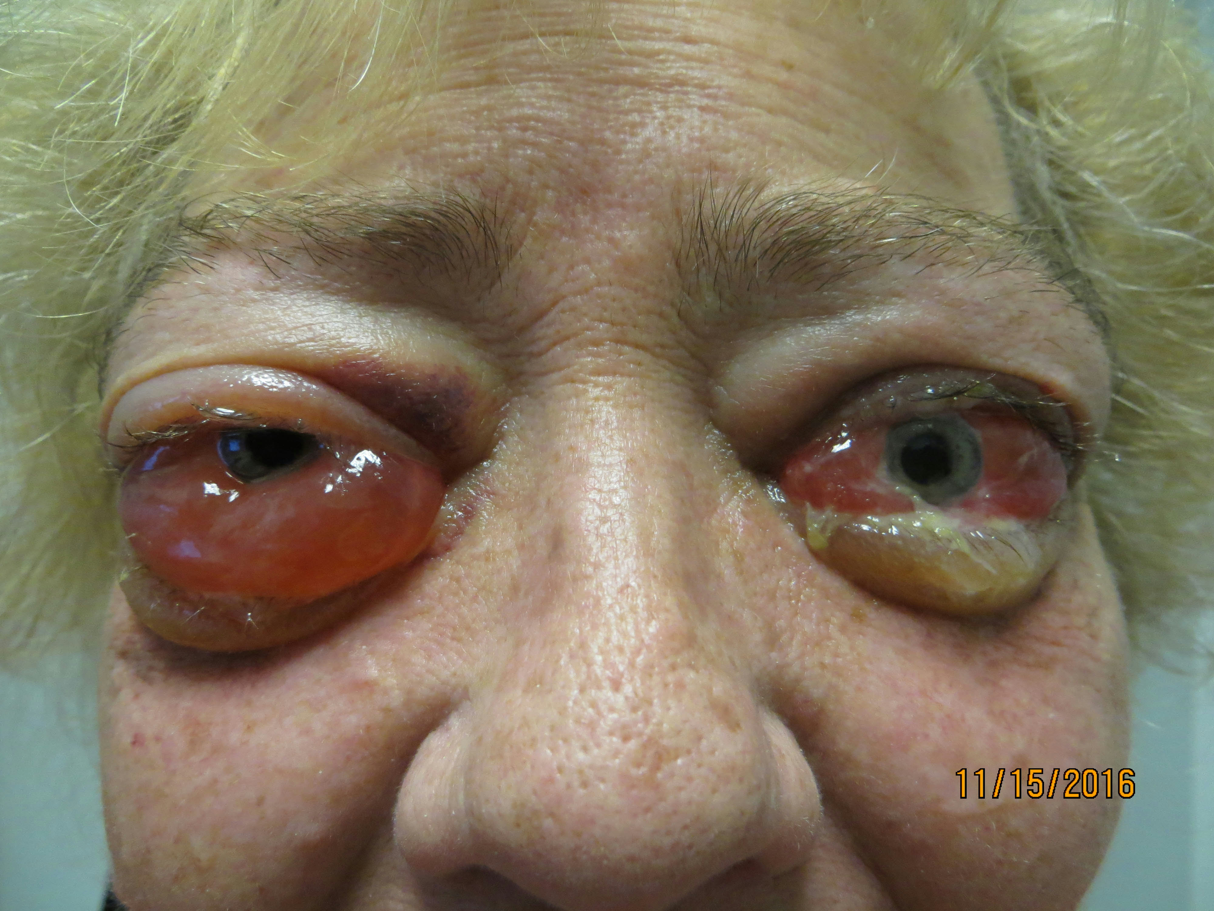 Moran Core Proptosis Graves Disease