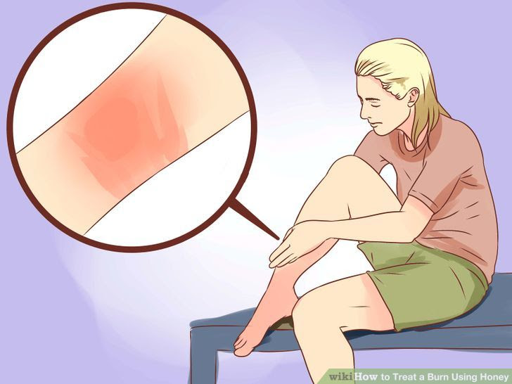 Treat a Burn Using Honey Step 1 Version 3.jpg