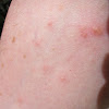Skin Cancer Types On Legs / Cancer: Visual Guide to Thyroid Cancer