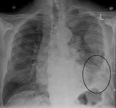Mesothelioma Definition - Signs & Symptoms Of Mesothelioma ...