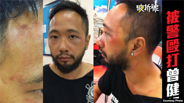 Hình ảnh ông Tsang thân thể bị bầm tím tại sở cảnh sát.