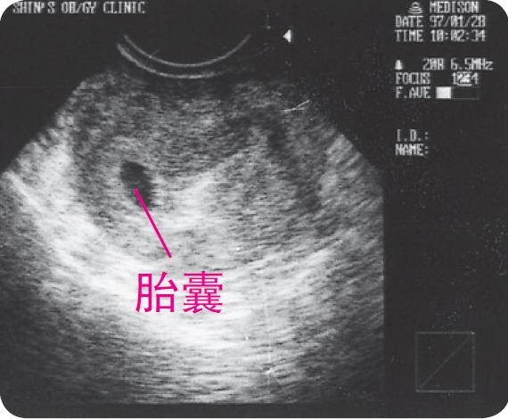 通过超声波图片看到孕10个月的胎儿 心脏