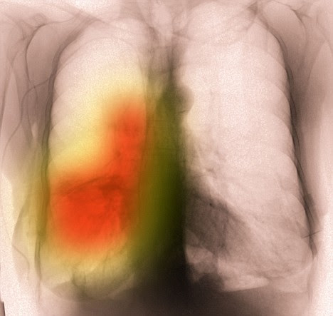 Diseased: The image shows before and after smoking lungs. Diseased: The image shows