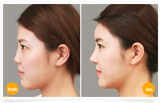 Nâng mũi không phẫu thuật giữ được bao lâu?