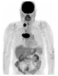 pet scan lung cancer