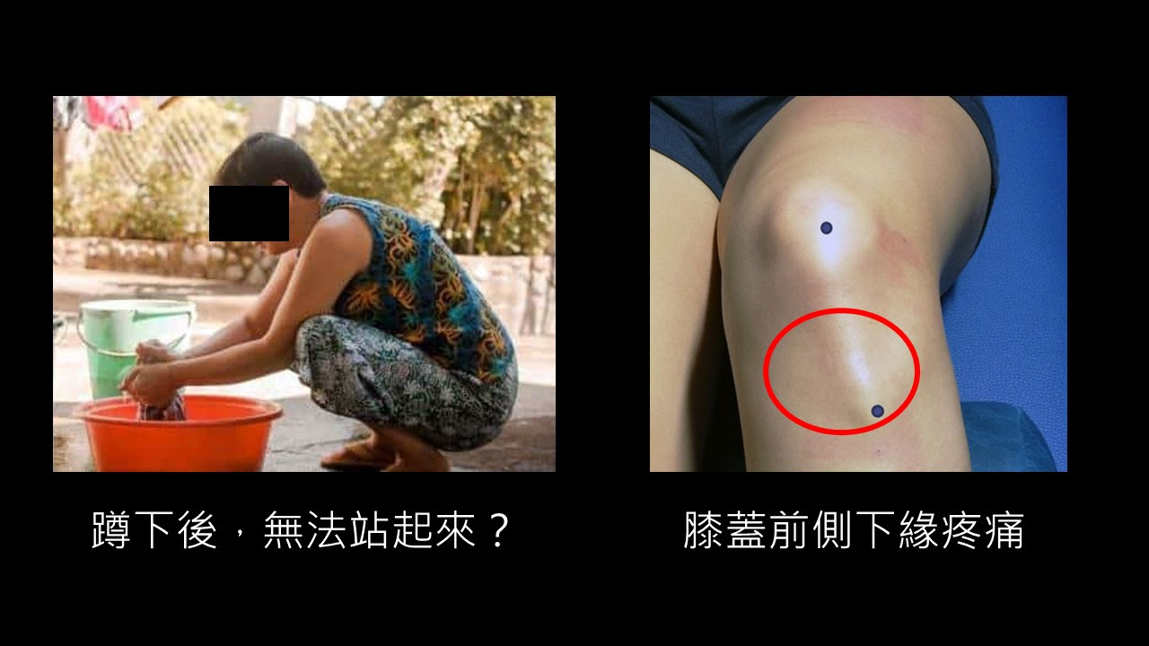 生昇診所前十字韌帶撕裂 可以不開刀嗎